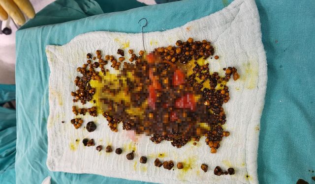 Manisa'da yaşlı kadının safra kesesinden sayısız taş çıkarıldı