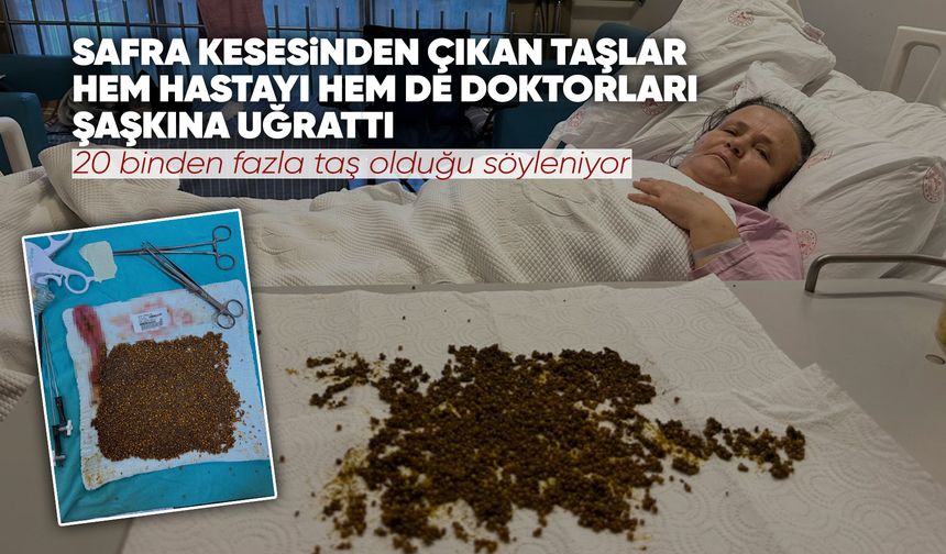 Manisalı kadının karnından 20 binden fazla taş çıktı