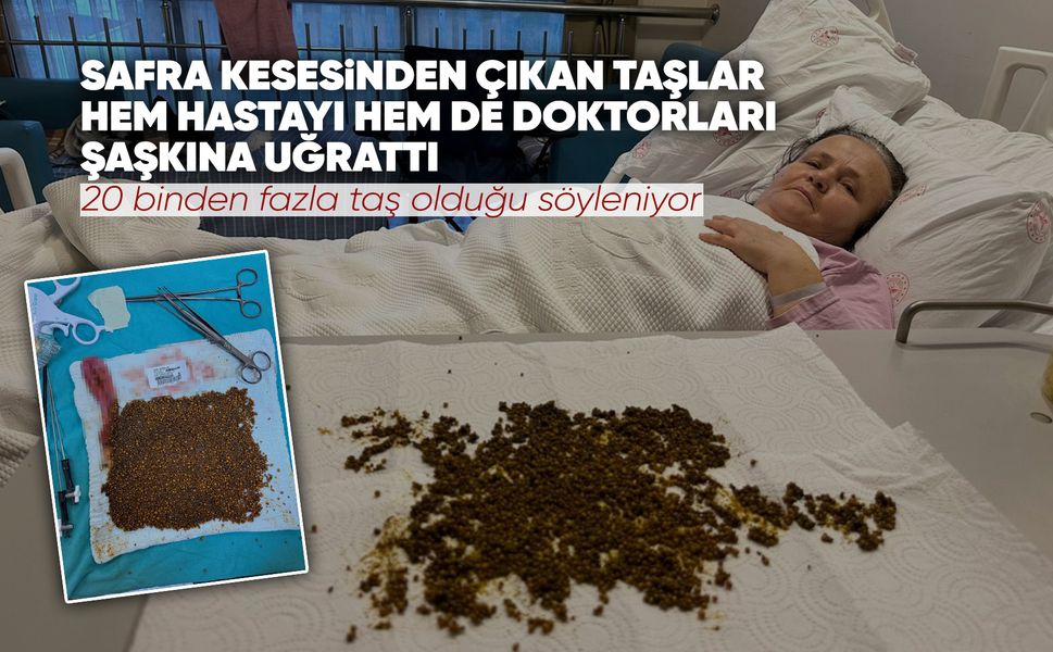 Manisalı kadının karnından 20 binden fazla taş çıktı